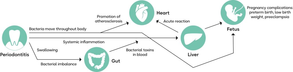 How periodontitis develops